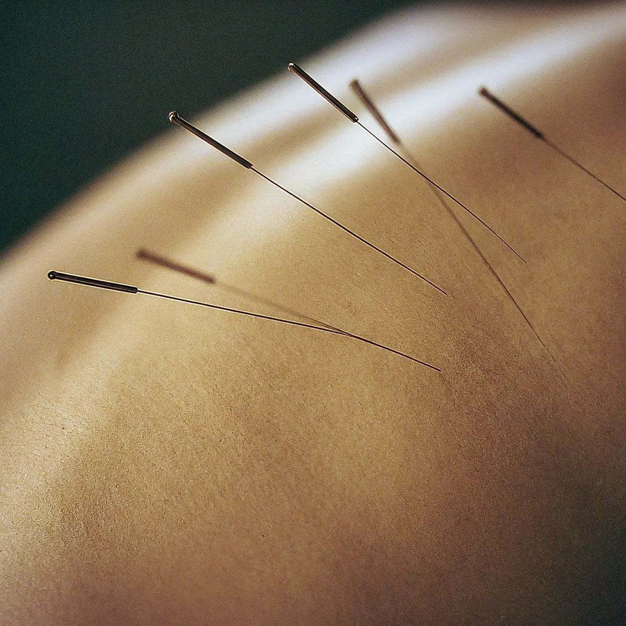 Close-up of acupuncture needles on a human back. 35mm stock photo